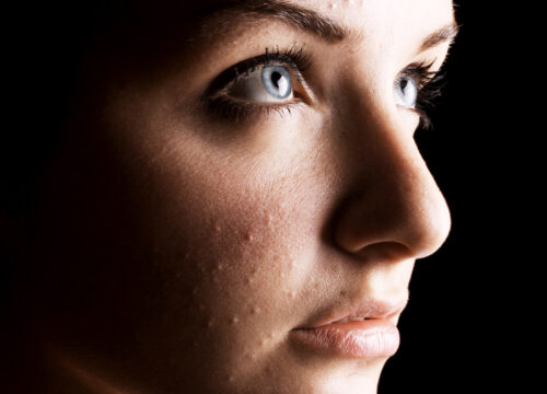 Photo of a woman with acne on her face