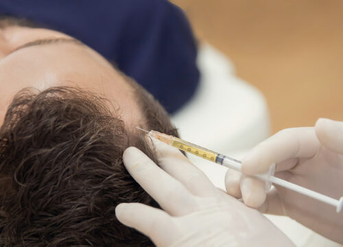 Photo of a man receiving hair regrowth injections