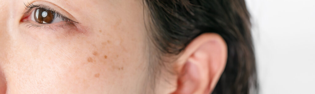 Hyperpigmentation Treatments Madison Avenue Aesthetics