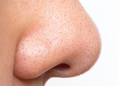 Photo of large pores on a man's nose