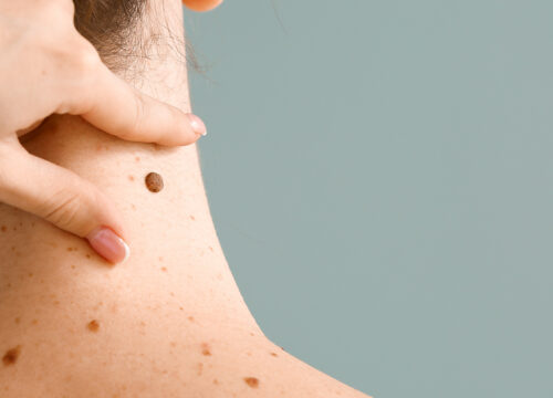 Photo of a woman with moles on the back of her neck