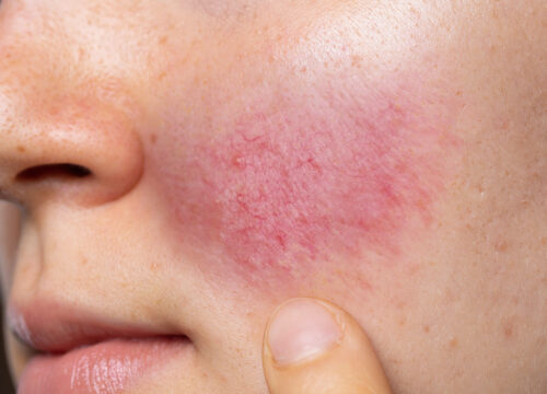 Photo of rosacea on a woman's cheek