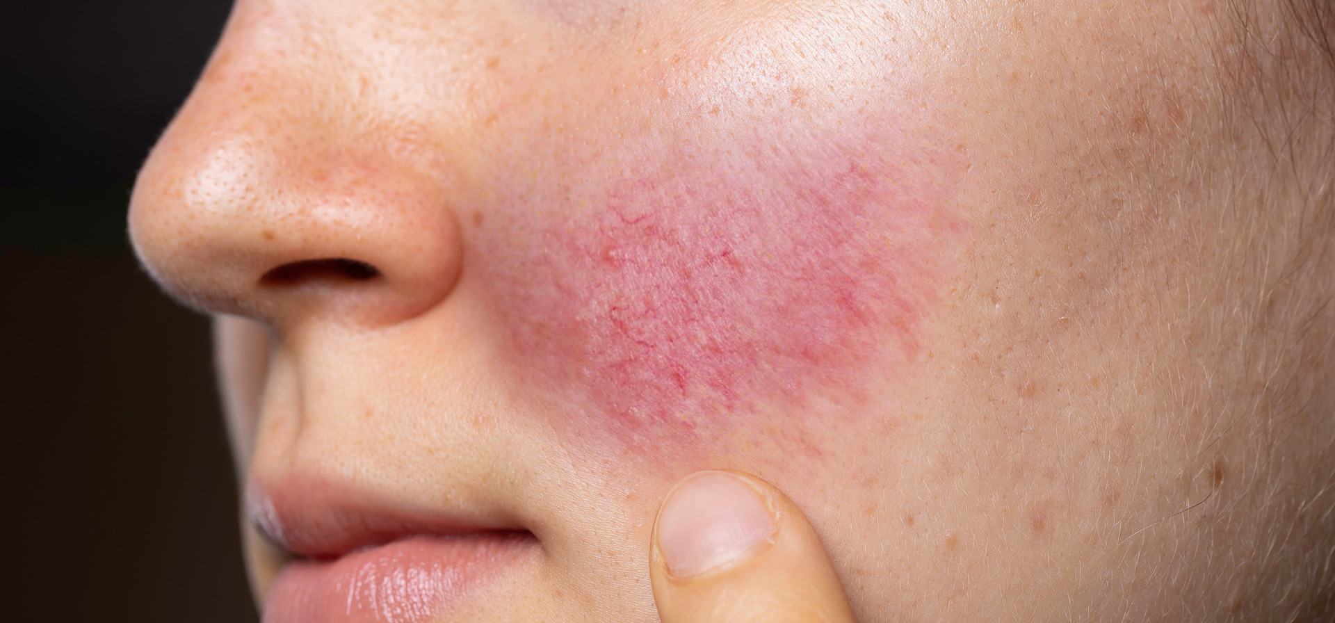 Rosacea