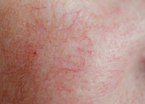 Photo of spider veins on a woman's face