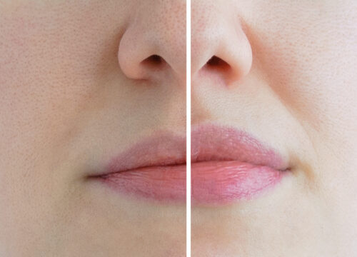 Side by side images of a woman's thin lips and full lips