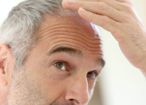 Photo of a man experiencing hair loss