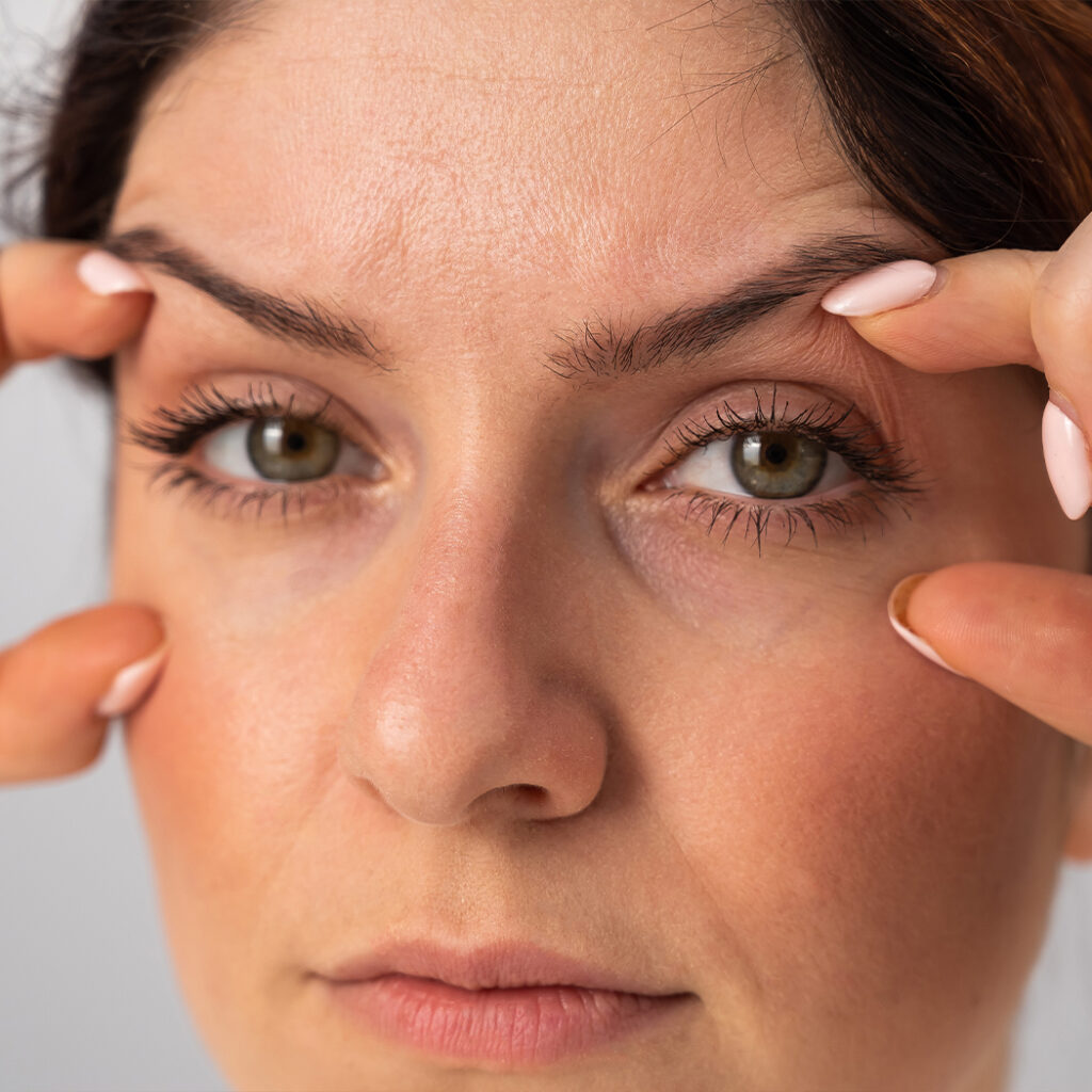 Photo of a woman with eyelid laxity