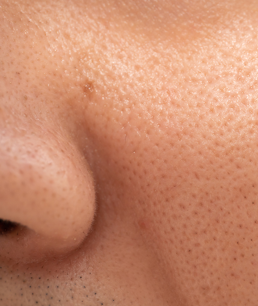 Close-up photo of large pores on a person's skin