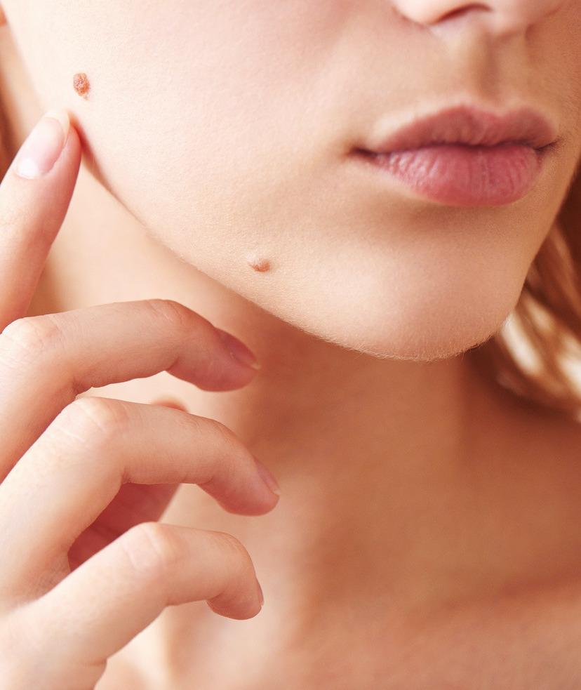 Photo of a woman with moles on her face