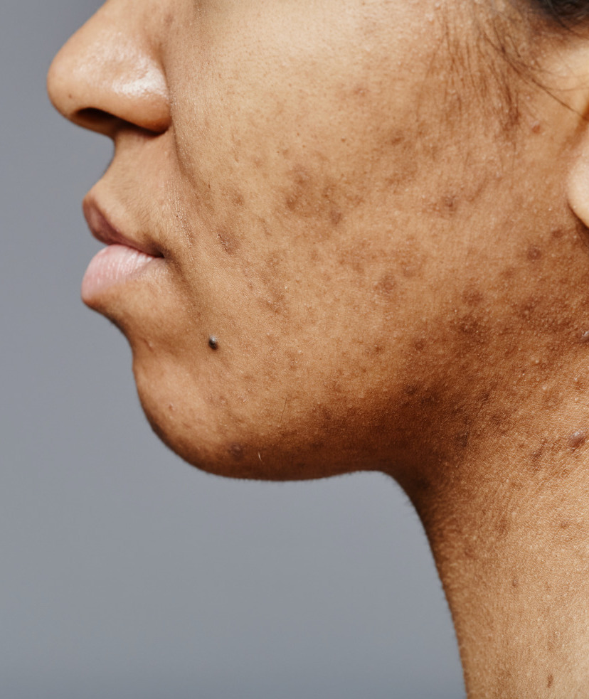 Photo of acne scars on a woman's face