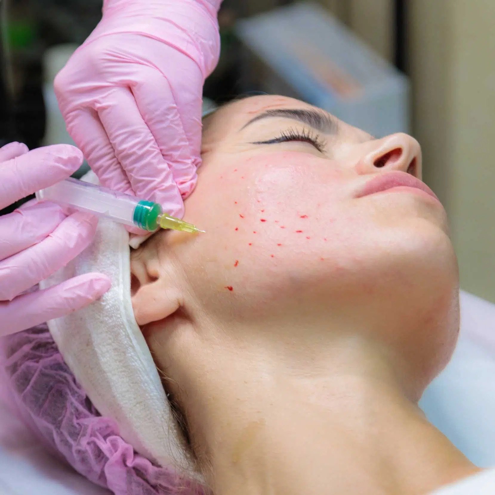 Photo of a patient receiving PRF facial injections