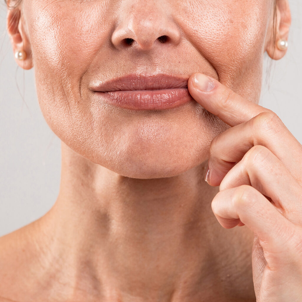 Photo of fine lines and wrinkles around a woman's mouth