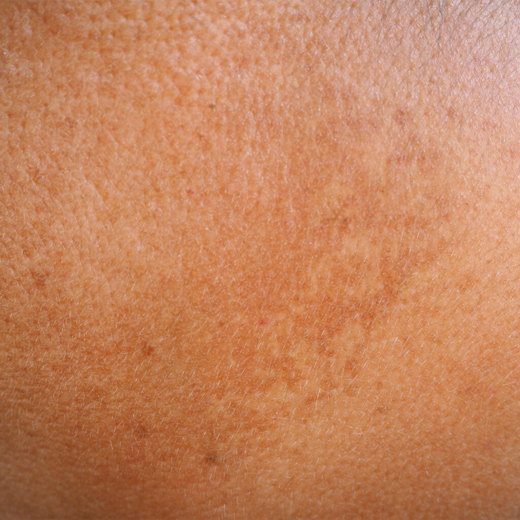 Photo of hyperpigmentation on a person's skin