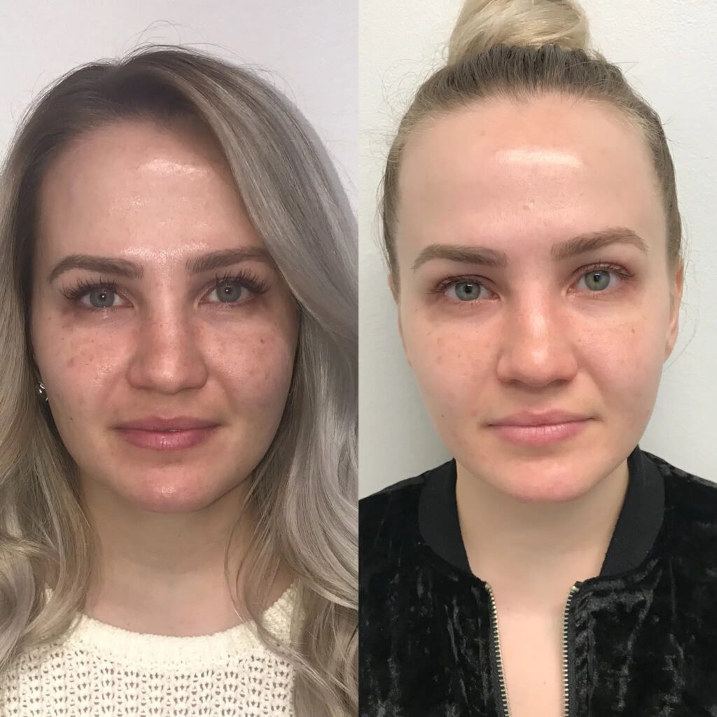 Before and after Bio-CARE® results