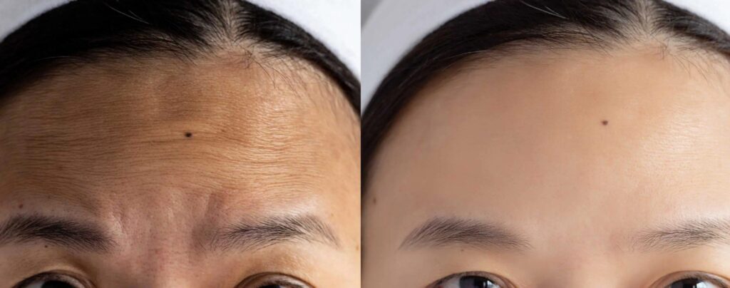 Before and after results for BOTOX® Cosmetic