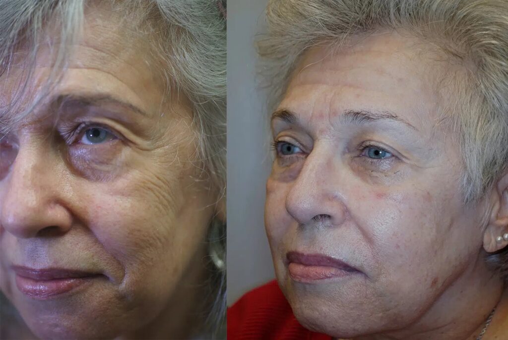 Before and after Fotona Laser Therapy results